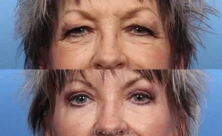 Upper Blepharoplasty Eyelid Surgery Before and After Results
