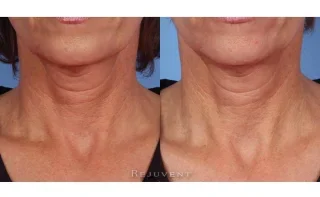 Neck skin firming with Nectifirm