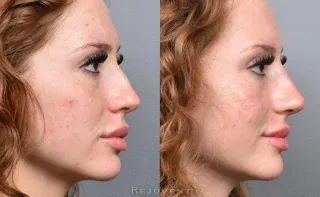 Non Surgical Nose Filler results smoother and straighter