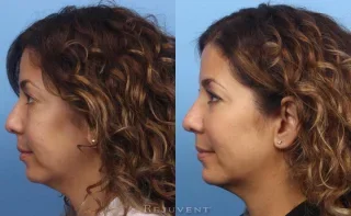 Non-surgical chin augmentation, nose filler and Liquid Facelift