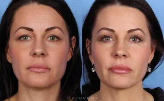 Upper and Lower eyelid surgery at Rejuvent, Scottsdale.