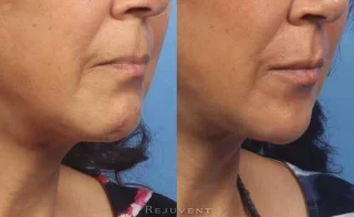 Lower Face Rejuvenation and Lip Augmentation