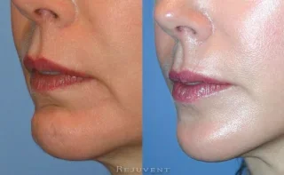 Chin and Facelift Patient 2