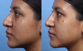 Beautiful non-surgical nose job in Scottsdale