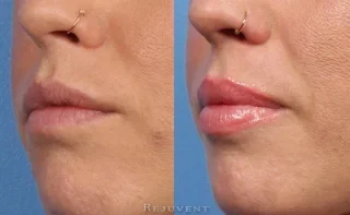 Plumper lips after lip injections at Rejuvent in Scottsdale AZ