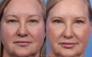 Beautiful Upper and Lower Blepharoplasty in Scottsdale