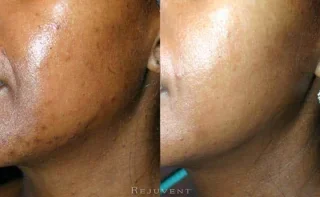 Acne Before and After patient 2