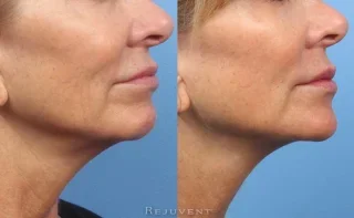 Rejuvenated lower face with dermal fillers