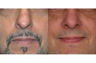 Nose tip refining with Rhinoplasty