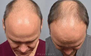 PRF MD injections for Hair Loss Male Frontal results