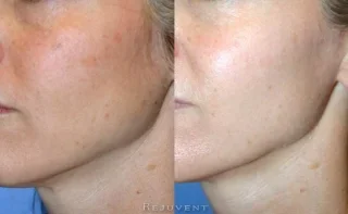 Patient in her 30s skincare results