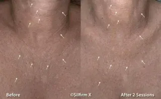 Sylfirm X neck before and after results