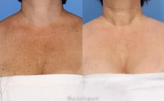 Chest Skin transformed by Spa Treatments