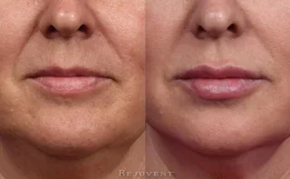 Beautiful Lips with injectable Lip Filler