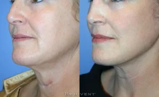 Scar Revision Patient Before and After Rejuvent