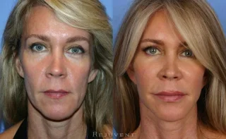 Facelift Surgery and Botox at Rejuvent
