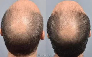 PRF MD injections for Hair Loss Male top view results