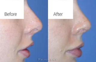 Closeup image of Before and after Rhinoplasty