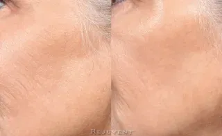 Moxi Before and Ftaer Results on cheek skin
