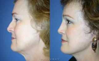 Nose surgery and facelift at Rejuvent Scottsdale side view 2