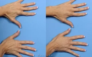 Hand results with injectable filler with Radiesse