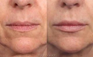 Aging Lips Rejuvenated with Dermal Fillers