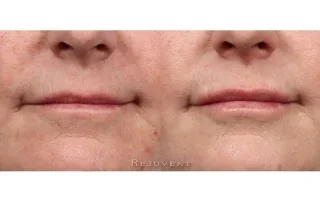 Lips before and after volumizing injections