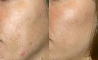 Acne and texture improvement