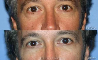 Perlane fillers for Under eye rejuvenation Scottsdale
