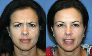 Botox Patient Forehead Wrinkles Scottsdale