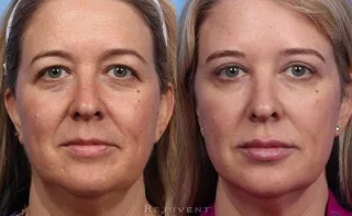 Upper Eyelid Surgery and Liquid Face Lift beautiful results