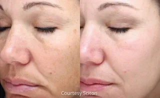 HALO Clear skin rejuvenations results