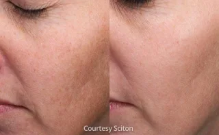 Moxi Laser results shows skin brighteness