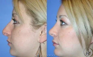Hump removal with Rhinoplasty