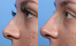 Non-Surgical Nose Filler in Scottsdale side view