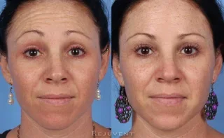 Botox on forehead before and after photo