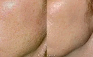 Dull, pigmented, poor texture corrected with Chemical Peels