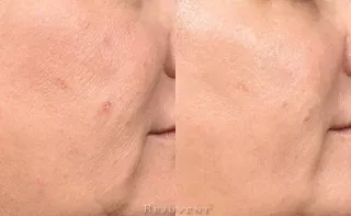 Moxi BBL results cheek closeup