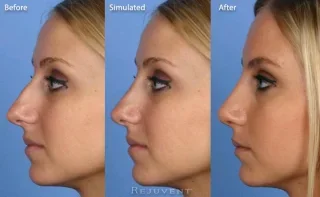 Side view with simulated and final rhinoplasty results