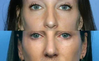 Non-Surgical Beautiful Results with Nose Filler