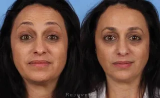 Botox - Dysport on forehead