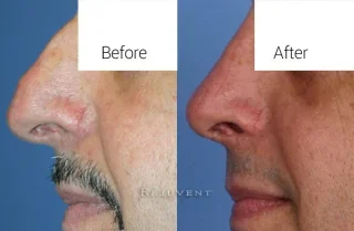 Male Patient After Rhinoplasty Hump Removal
