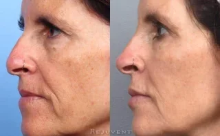 Nose Filler Long Term Before and After Results