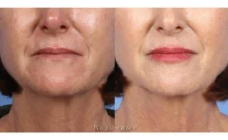 Lip injection with filler