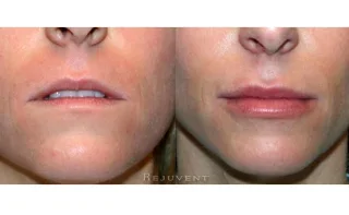 Fuller Lips less lines Female 2