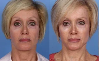 Facelift with Jowl and Jawline Improvement