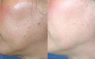 Tigther, Brighter, Better texture after skin treatments