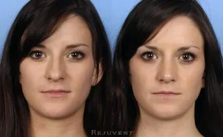 Rhinoplasty Nose Surgery 20s patient Front View