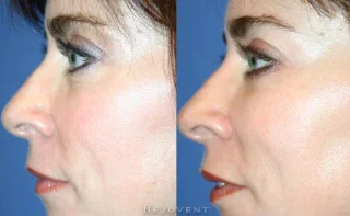Lower Bleph Eyelid Surgery Frontal view Rejuvent Scottsdale