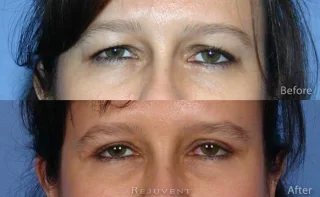 Upper Bleph eyelid surgery eyes view